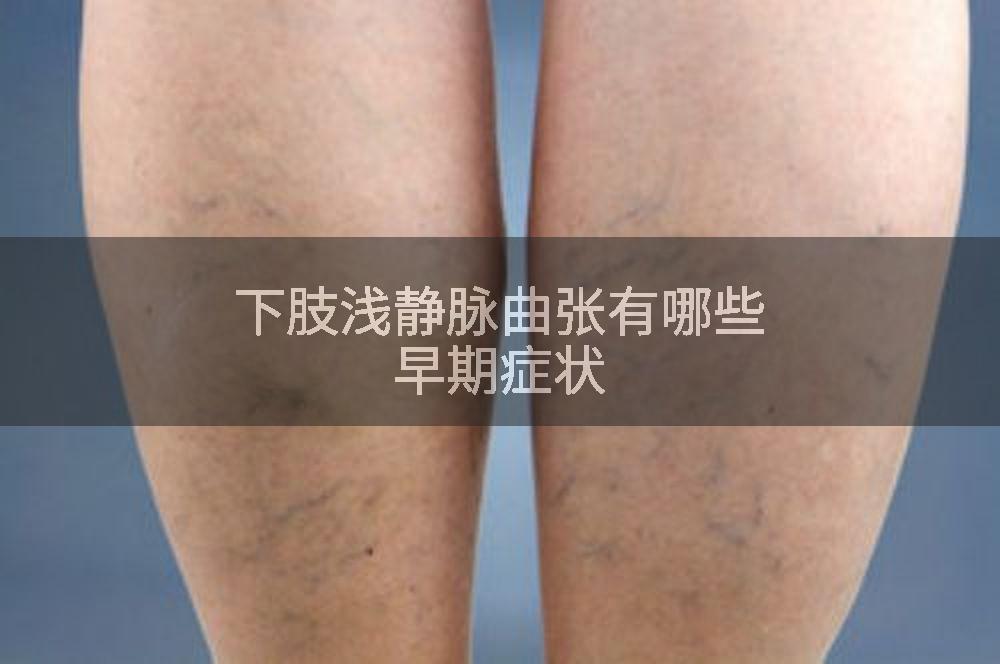 下肢浅静脉曲张有哪些早期症状