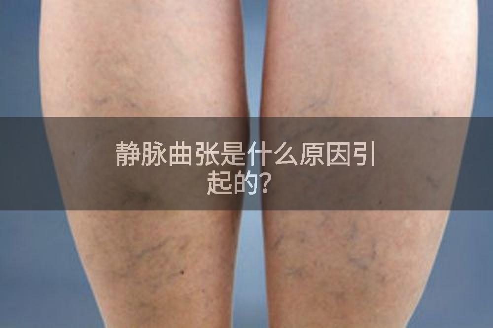静脉曲张是什么原因引起的？