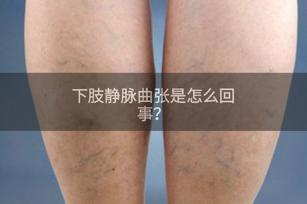 下肢静脉曲张是怎么回事？