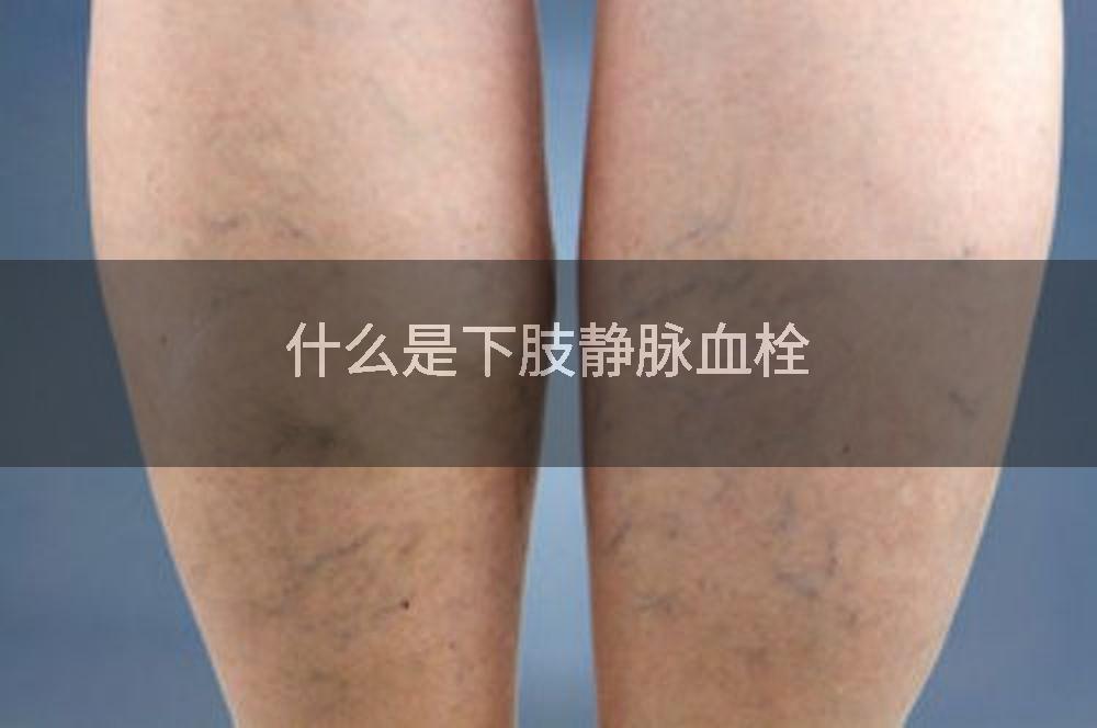 什么是下肢静脉血栓