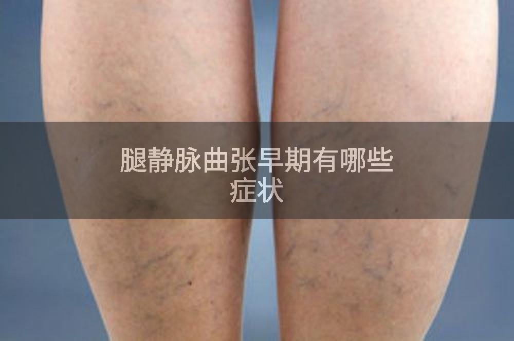 腿静脉曲张早期有哪些症状