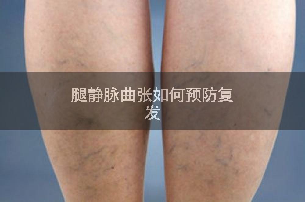 腿静脉曲张如何预防复发