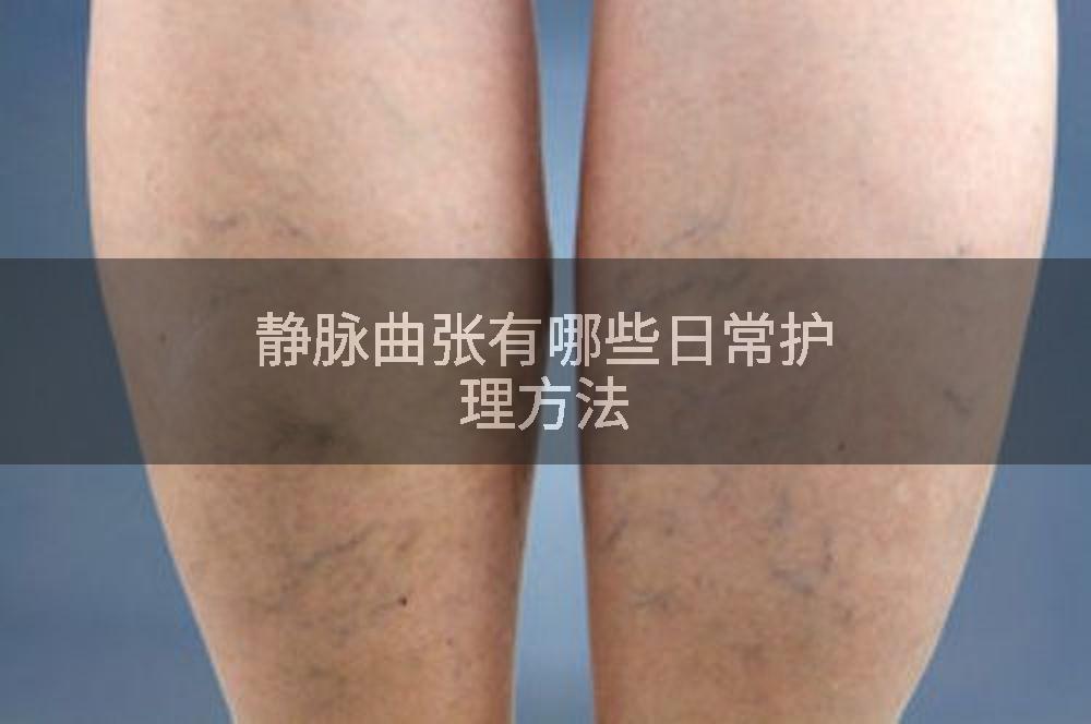 静脉曲张有哪些日常护理方法