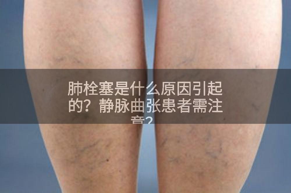 肺栓塞是什么原因引起的？静脉曲张患者需注意？