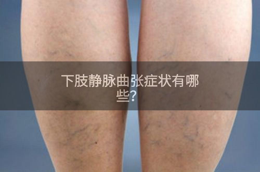 下肢静脉曲张症状有哪些？