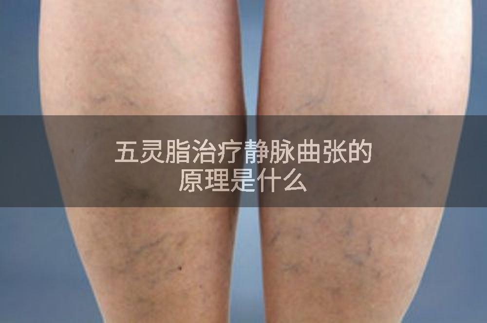 五灵脂治疗静脉曲张的原理是什么