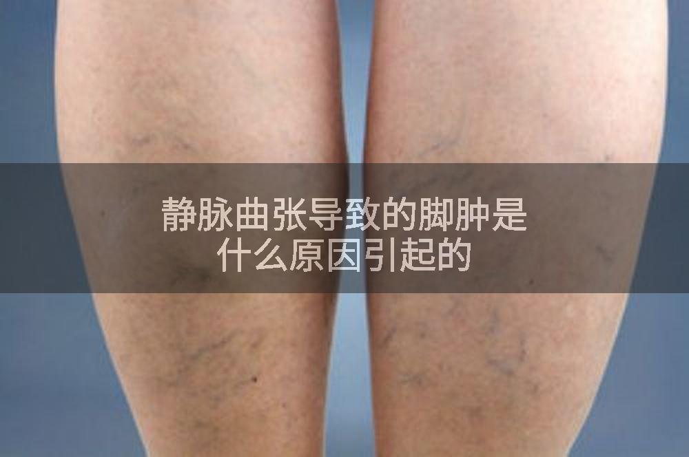 静脉曲张导致的脚肿是什么原因引起的