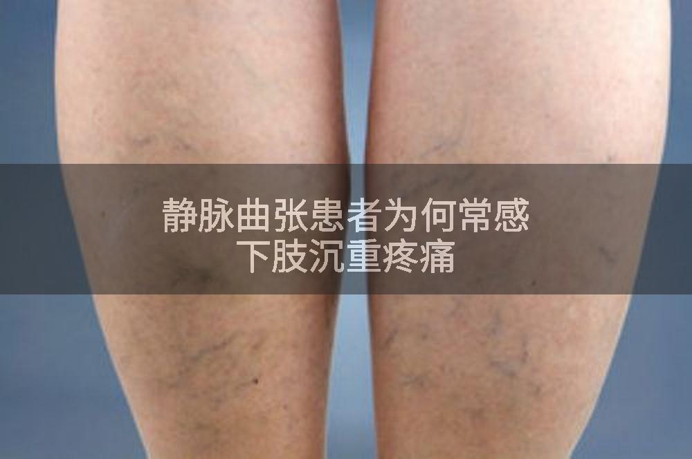 静脉曲张患者为何常感下肢沉重疼痛