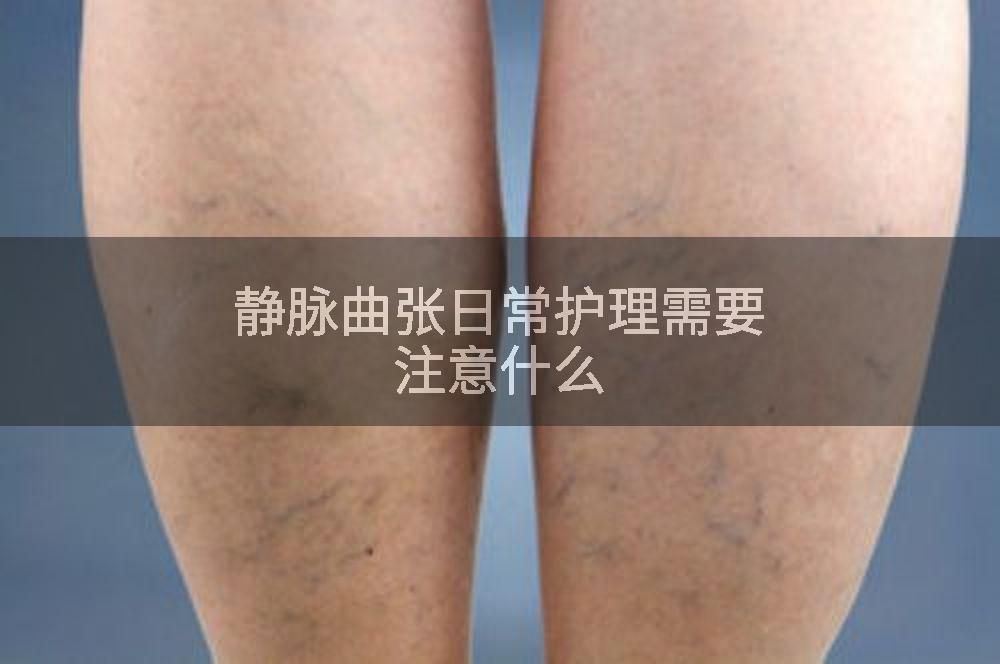 静脉曲张日常护理需要注意什么