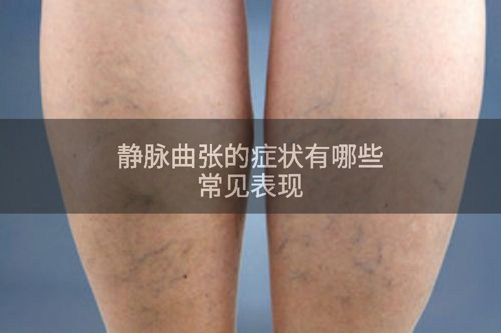 静脉曲张的症状有哪些常见表现