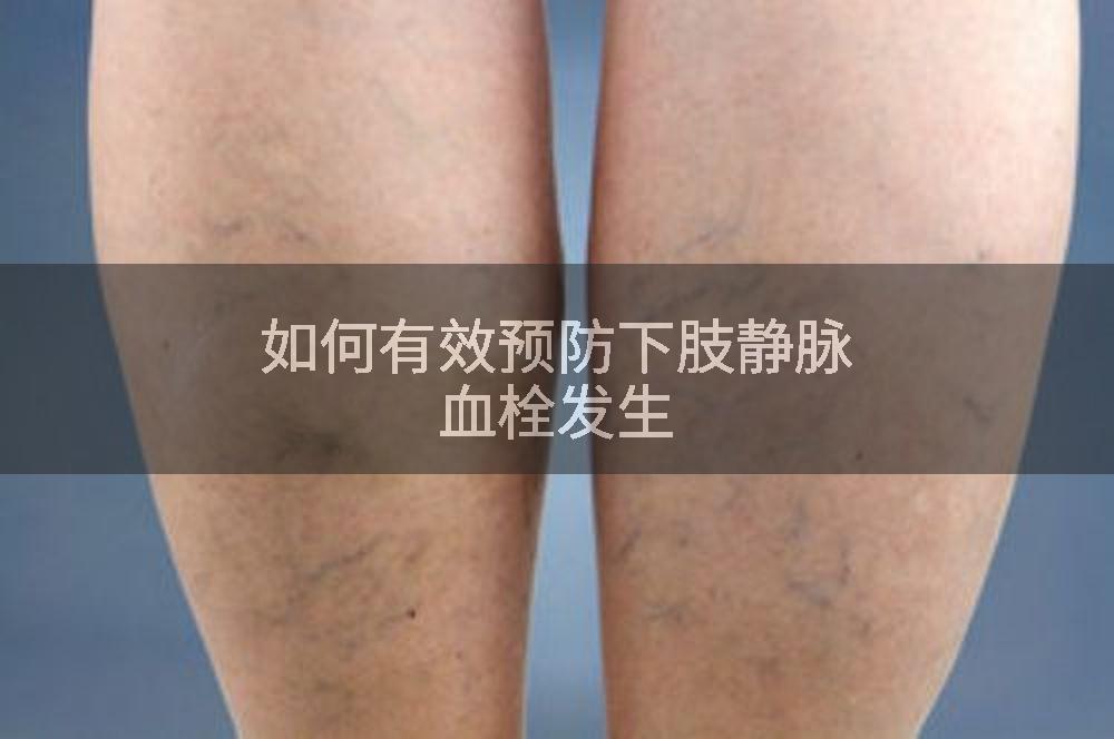 如何有效预防下肢静脉血栓发生