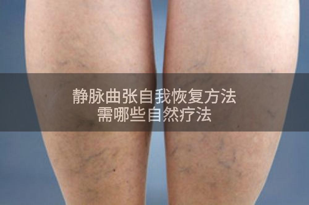 静脉曲张自我恢复方法需哪些自然疗法
