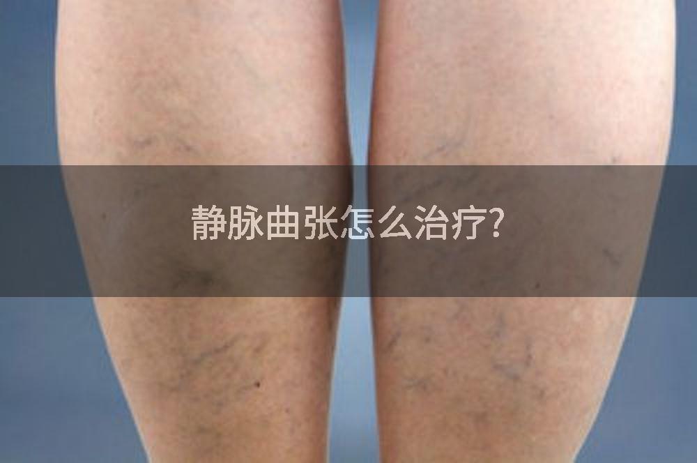 静脉曲张怎么治疗?