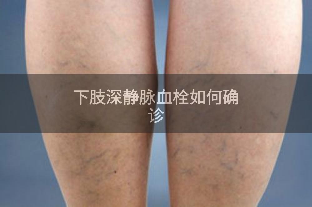 下肢深静脉血栓如何确诊