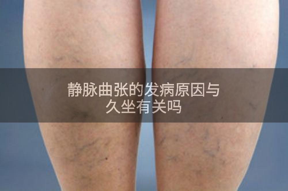 静脉曲张的发病原因与久坐有关吗