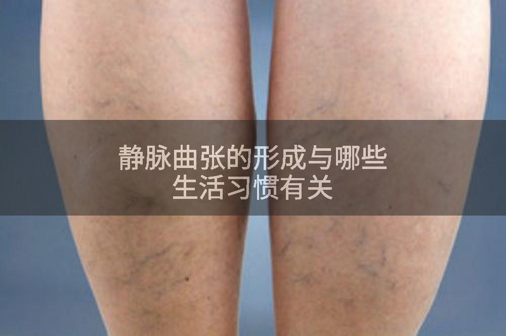 静脉曲张的形成与哪些生活习惯有关