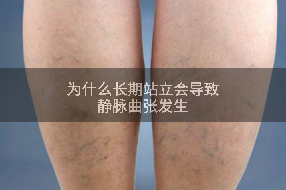 为什么长期站立会导致静脉曲张发生