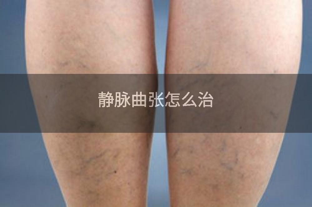 静脉曲张怎么治