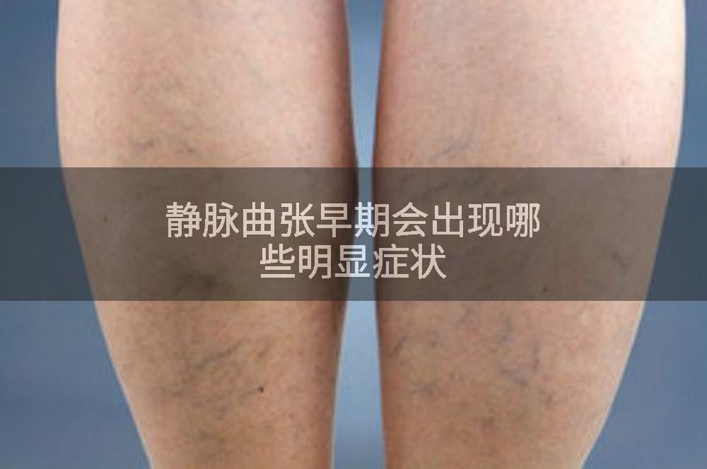 静脉曲张早期会出现哪些明显症状