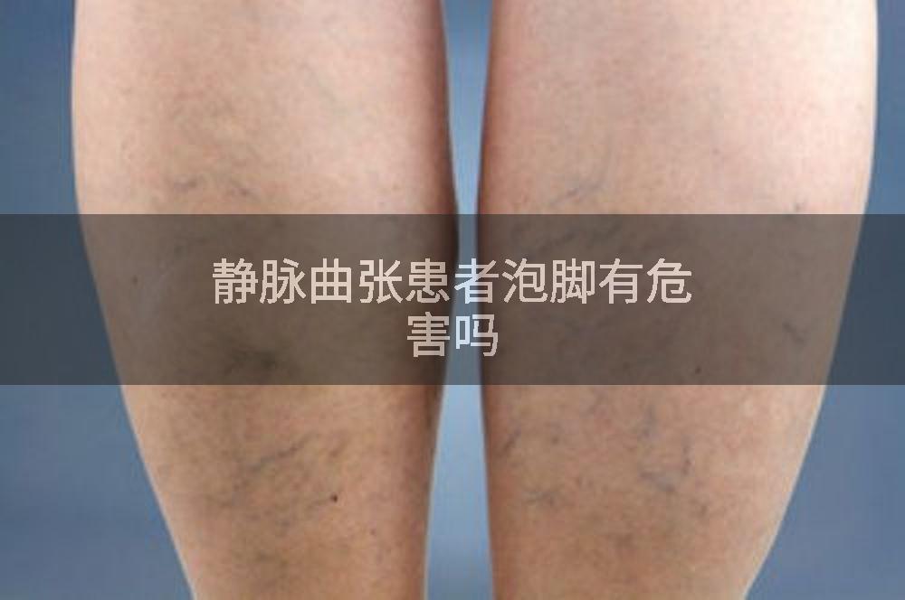 静脉曲张患者泡脚有危害吗