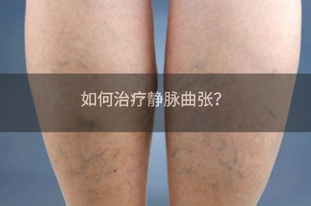 如何治疗静脉曲张？