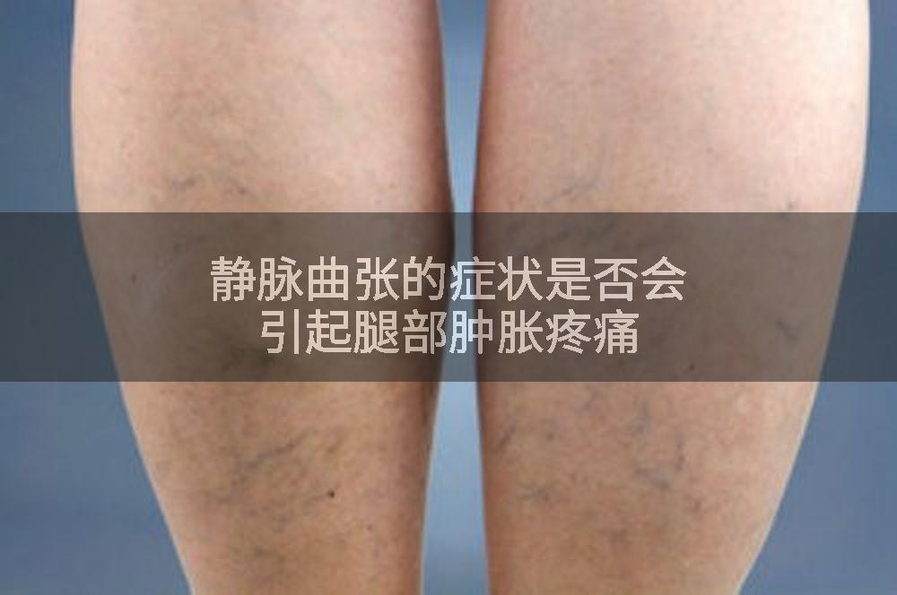 静脉曲张的症状是否会引起腿部肿胀疼痛