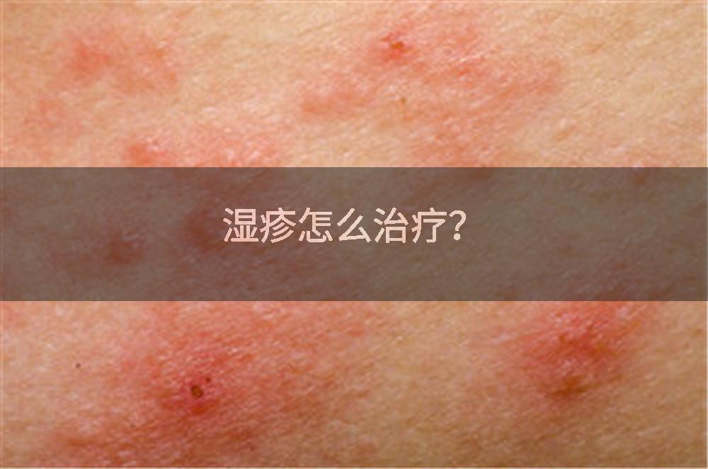 湿疹怎么治疗？