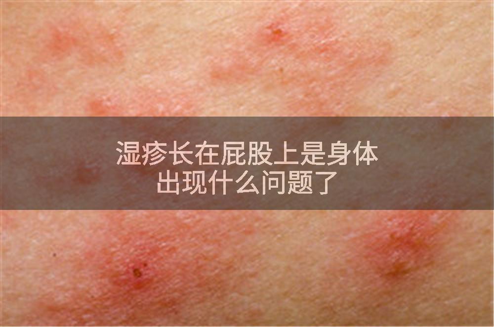 湿疹长在屁股上是身体出现什么问题了