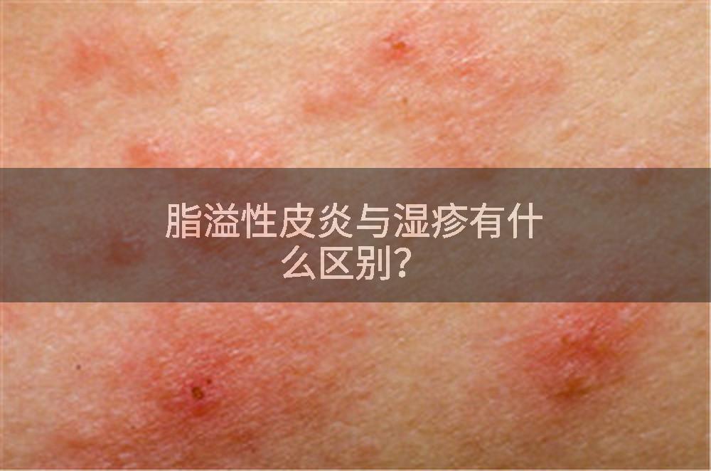 脂溢性皮炎与湿疹有什么区别？