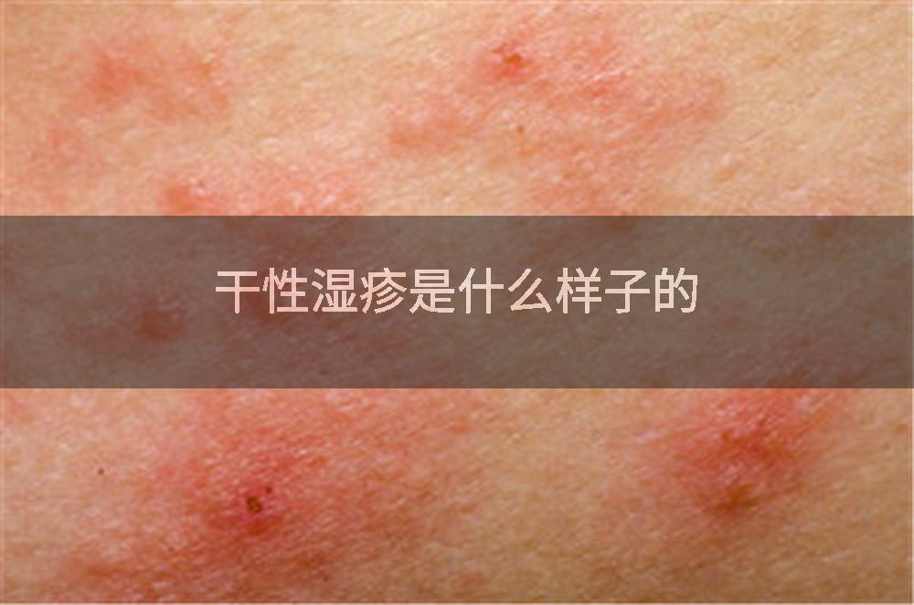 干性湿疹是什么样子的