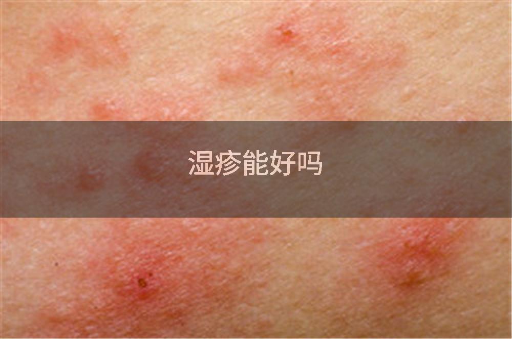 湿疹能好吗
