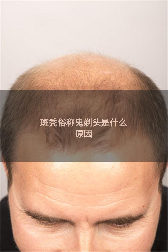 斑秃俗称鬼剃头是什么原因