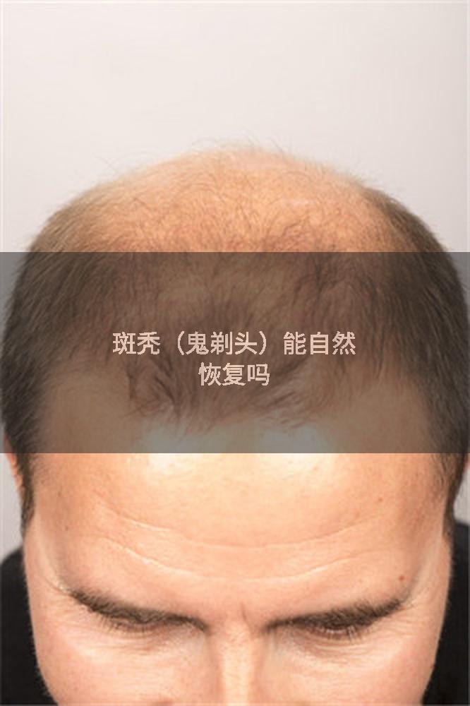 斑秃（鬼剃头）能自然恢复吗