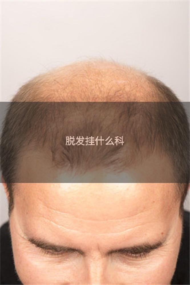 脱发挂什么科