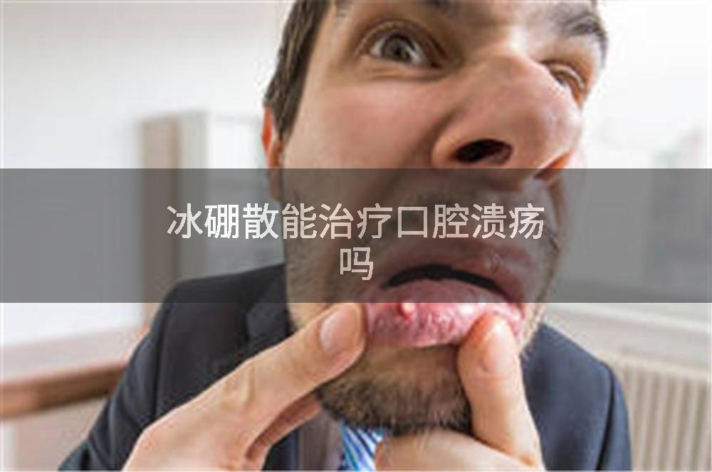 冰硼散能治疗口腔溃疡吗