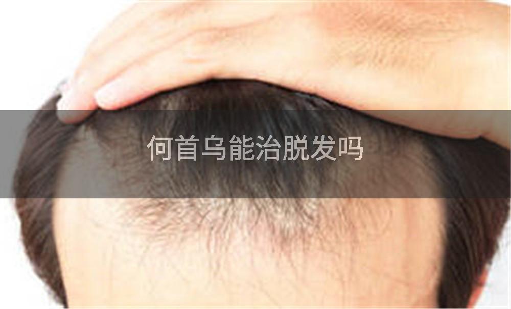 何首乌能治脱发吗