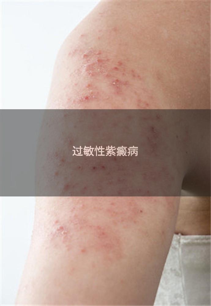 过敏性紫癜病