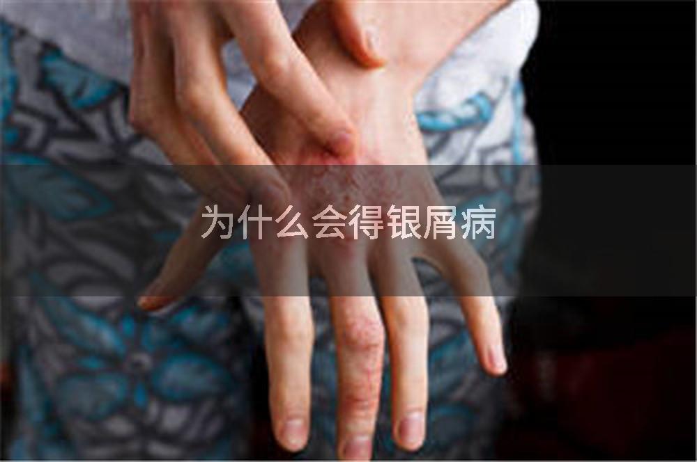 为什么会得银屑病