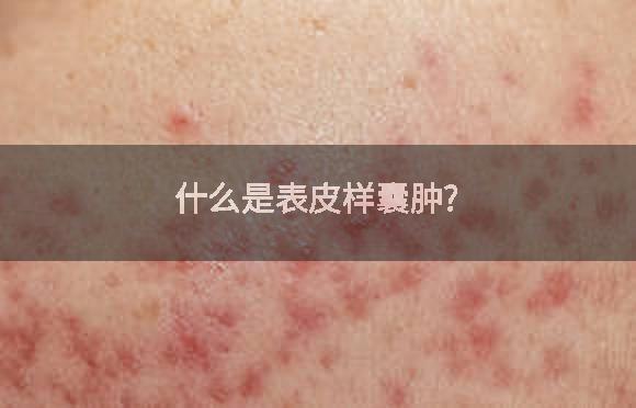 什么是表皮样囊肿?