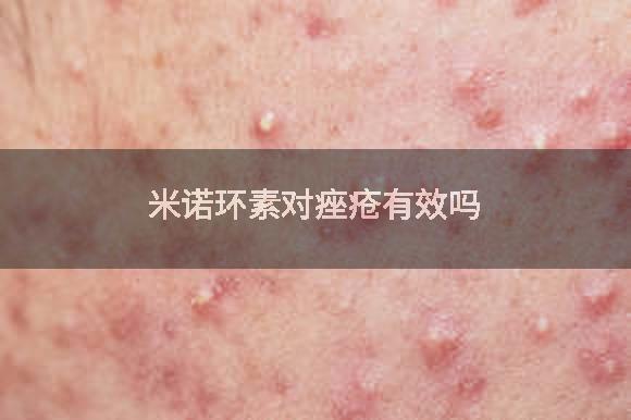 米诺环素对痤疮有效吗