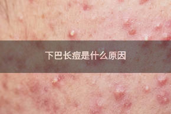 下巴长痘是什么原因
