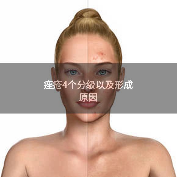 痤疮4个分级以及形成原因
