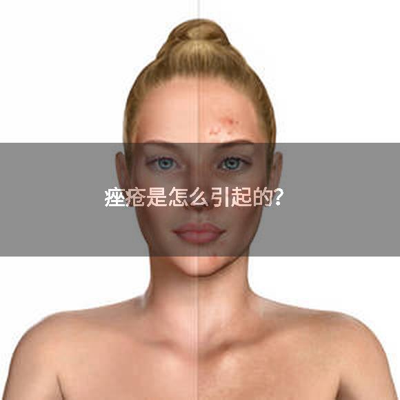 痤疮是怎么引起的？