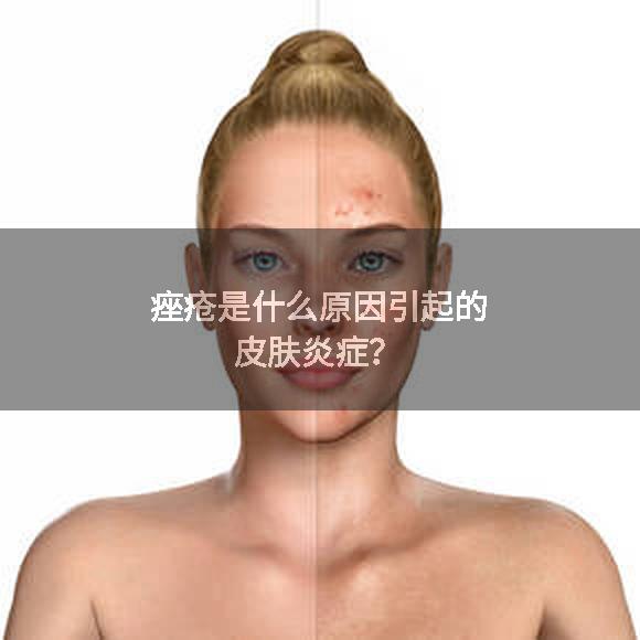 痤疮是什么原因引起的皮肤炎症？