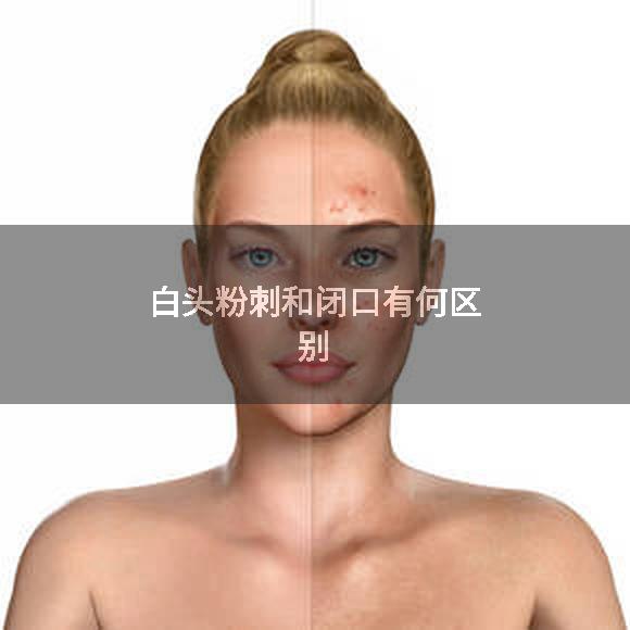 白头粉刺和闭口有何区别