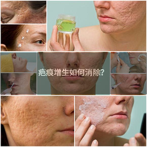 疤痕增生如何消除？