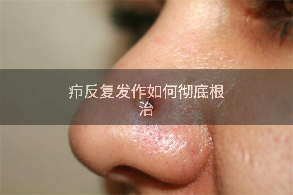疖反复发作如何彻底根治