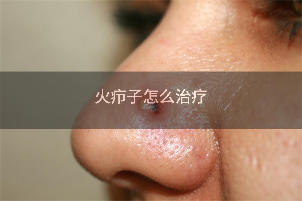 火疖子怎么治疗