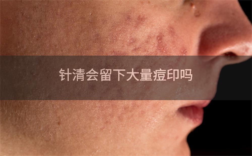 针清会留下大量痘印吗