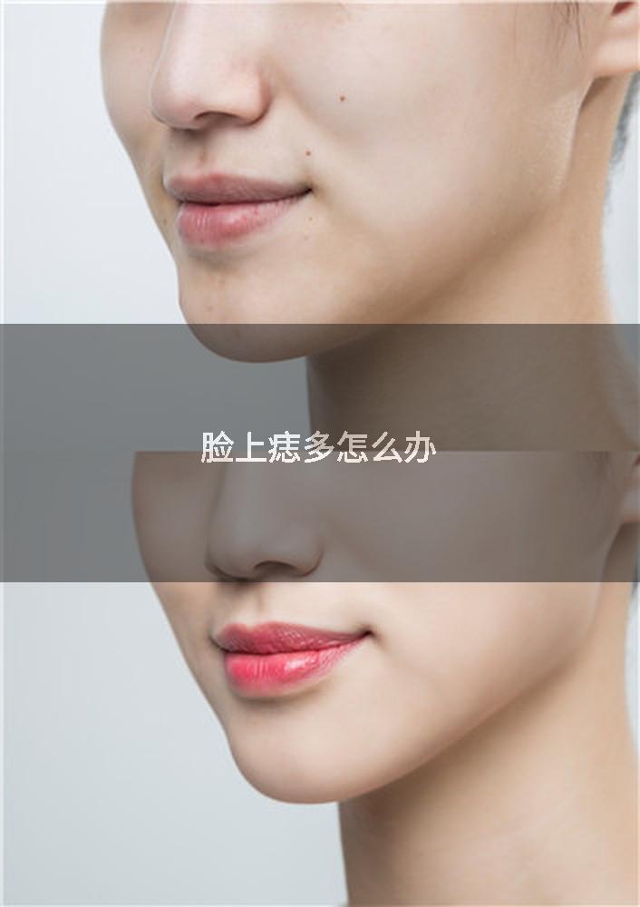 脸上痣多怎么办